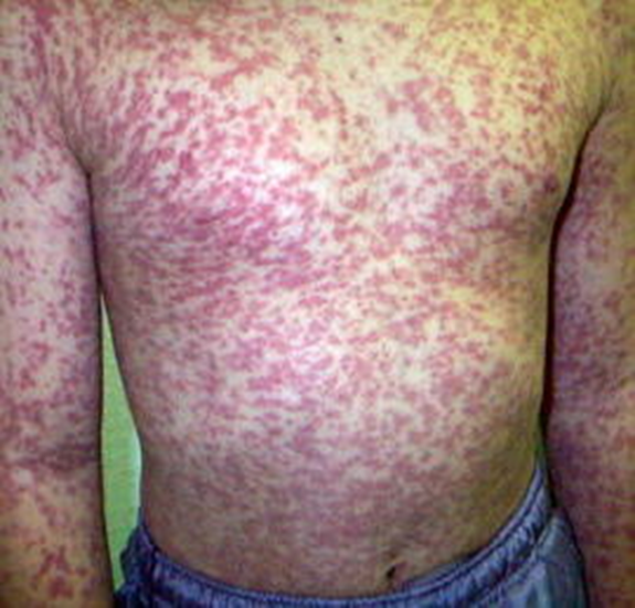 公式 麻疹 はしか の感染拡大の脅威 エアロシールド株式会社